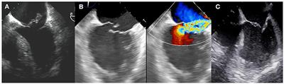 Percutaneous mitral valve repair in patients developing severe mitral regurgitation early after an acute myocardial infarction: A review